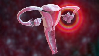 An illustration of a uterus, fallopian tubes and ovaries shows an inflamed, cyst-filled ovary on the right side due to PCOS, while the ovary on the left appears normal.