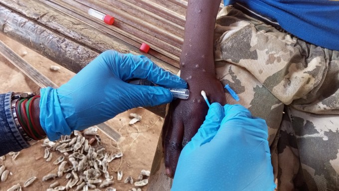 The hands of a health care worker wearing gloves hold a vial and a swab that's being used to collect a sample from a person with a rash on their arm.